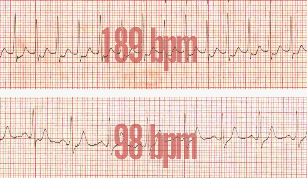 Two EKG charts of a heart rate stacked on top of one another. The top reads "189 bpm" with a noticeably busier rhythm. The bottom chart reads "98 bpm" with a calmer rhythm. 