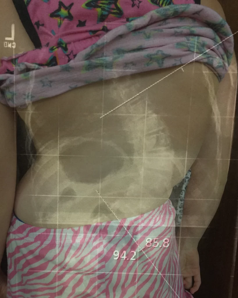X-ray overlay of Abby's back.