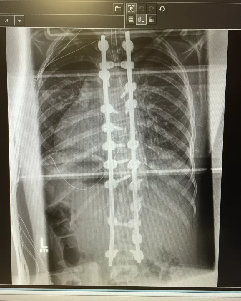 A photo of Abby's back x-ray post surgery.