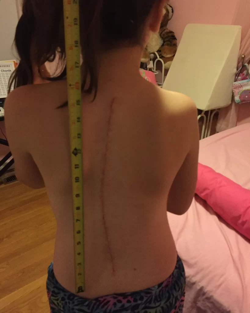 A photo of Abby's back showing her surgery scar.