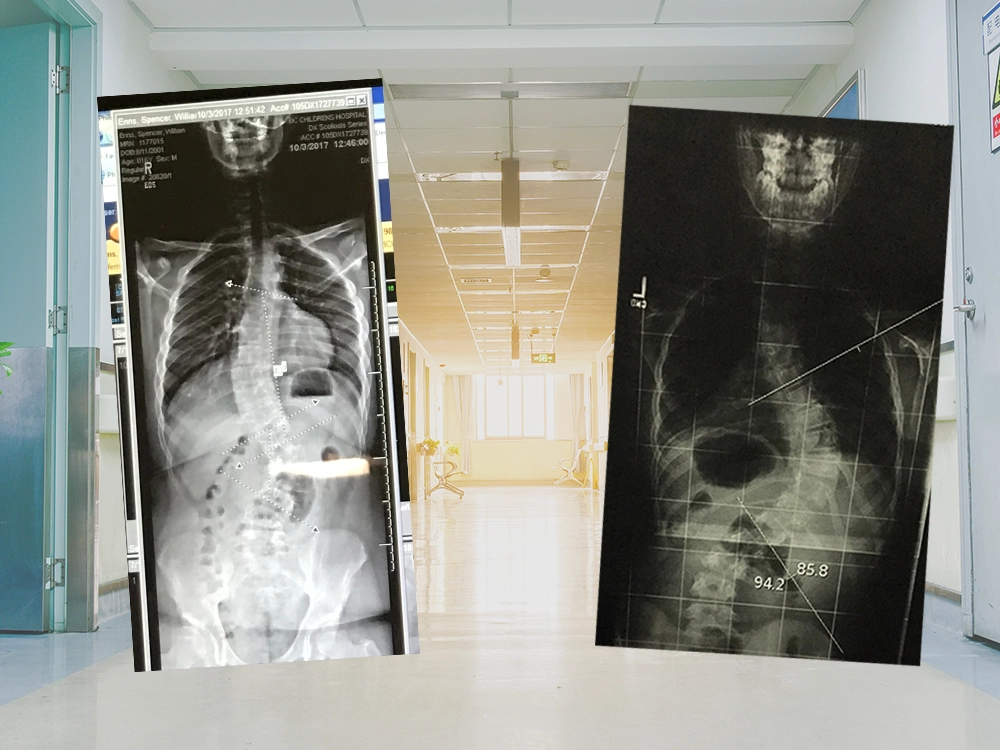 Images of two different x-rays over top of a hospital hallway.